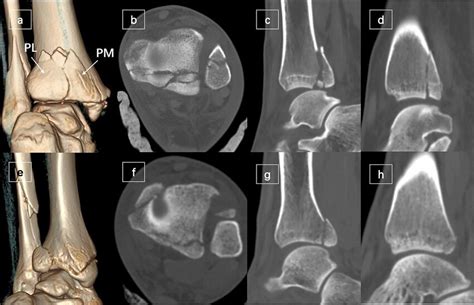 The Different Morphologies Of Pilon And Avulsion Subtypes Of Posterior