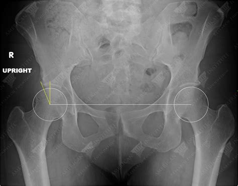 Borderline Dysplastic Female Patients With Painful Internal Snapping