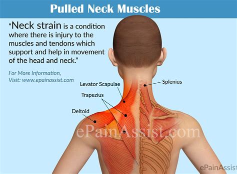 Neck Muscles Pulled Neck Muscle Neck Muscle Anatomy Muscles Of The Neck