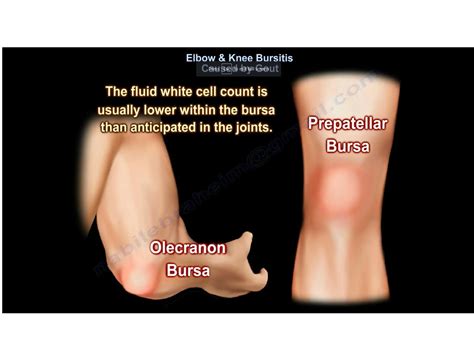 Elbow And Knee Bursitis Caused By Gout —