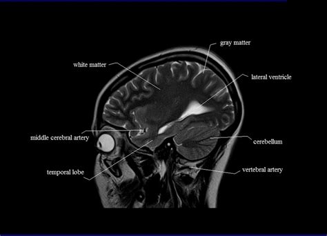 Cross Sectional Anatomy | MRI Brain Sagittal Anatomy | Free MRI brain ...