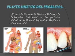 Enfermedad Periodontal Y Diabetes Pptx