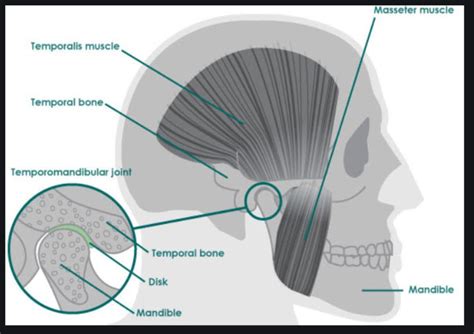 Slipped Disc Jaw Surgery Olivia Underwood