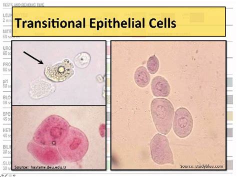 Transitional Renal Epithelial Cells In Urine