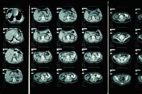 What Is A CT Scan What The Test Detects And How It Works