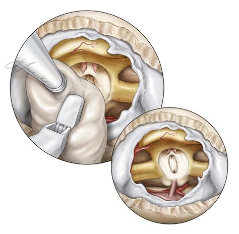 Principles Of Intraventricular Surgery The Neurosurgical Atlas