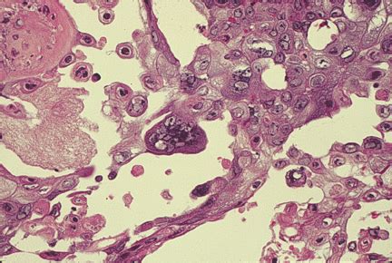 Herpetic Stomatitis Histology