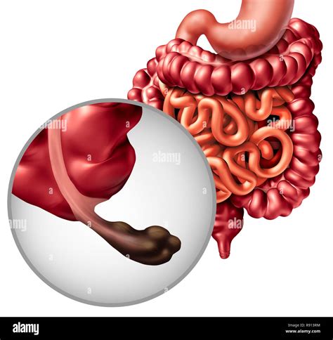 Anhang Krebs Und Darm Krankheit Oder Gastrointestnal Verdauung Mit