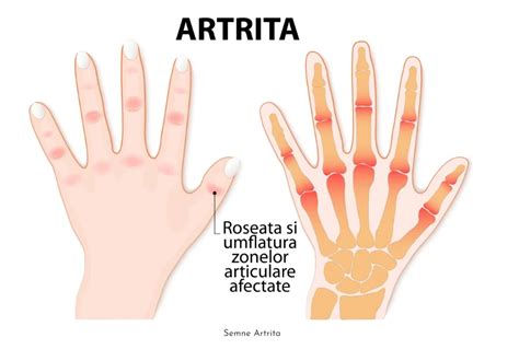 Artrita Cauze Si Tratamentul Acesteia Biomedscan