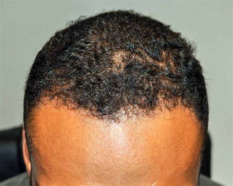 500 Graft Hair Transplant Coverage Results Costs