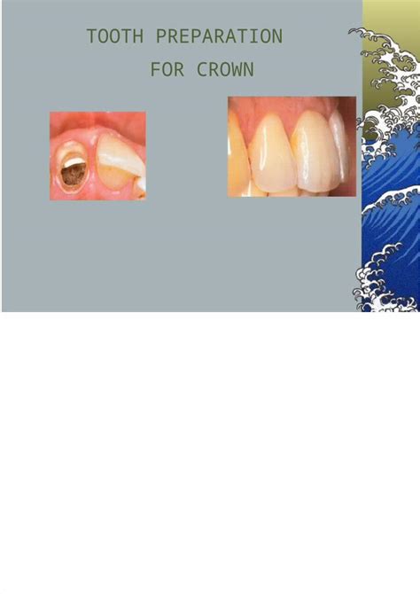 (PPT) Tooth Preparation for Crown - DOKUMEN.TIPS