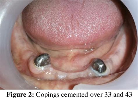 Figure 2 From Tooth Supported Overdenture With Short Copings A Case