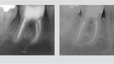 Overfilling Endodontic Failure Vs Clinical Success Style Italiano