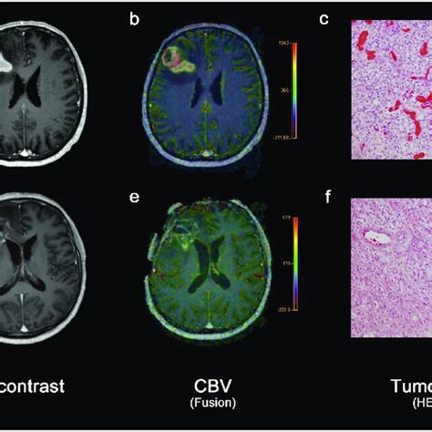 Rcbv Max At Initial Diagnosis And Progression Relative Cerebral