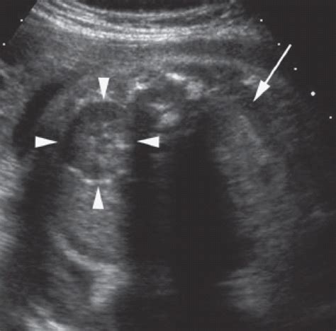 Genitourinary Tract Obgyn Key