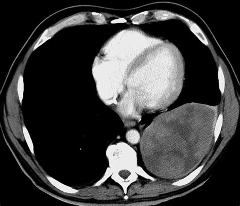 Imaging Features Of Solitary Fibrous Tumors AJR