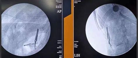 惊了！宝鸡22岁男子下腹疼痛难忍，没想到医生竟从他体内取出两根钢针！患者王海龙异物