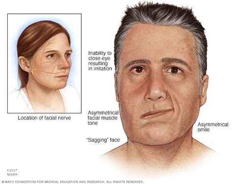 File Bells Palsy 1 Webp Physiopedia