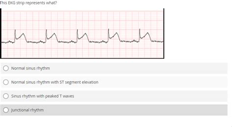 Solved Normal Sinus Rhythm Normal Sinus Rhythm With St