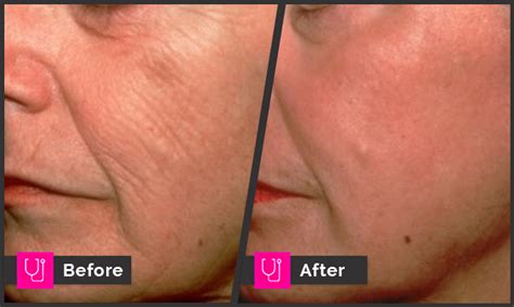 Wrinkles Sun Damage Main Line For Laser Surgery In Ardmore Pa