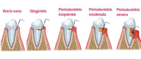 Qu Es La Periodontitis Y C Mo Tratarla