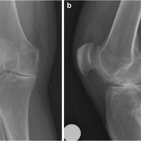 A Anteroposterior And B Lateral Plain Radiographs Of The Knee