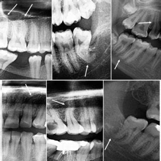 Distributions of dilacerated teeth by age and side | Download Table