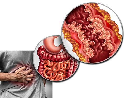 What To Know About Crohns Disease And Colitis