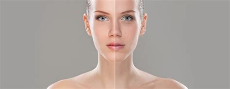 Aqualyx Fat Dissolving Injections Face North West Aesthetics