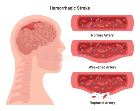 Hemorrhagic Brain Stroke Damaged Human Brain Weakend And Ruptured Stock Vector Illustration