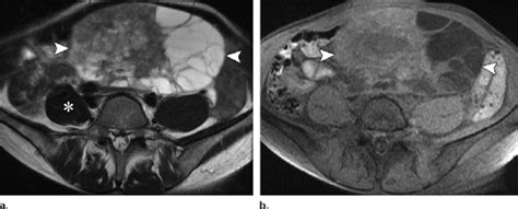 Borderline Mucinous Ovarian Neoplasm In A 52 Year Old Woman A Axial