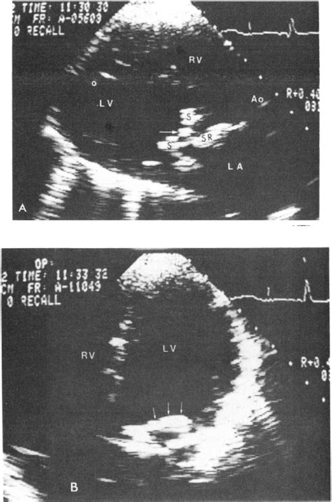 Figure 1 From Two Dimensional Echocardiographic Assessment Of