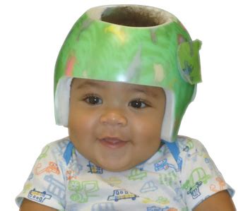 Cranial Helmet On Baby