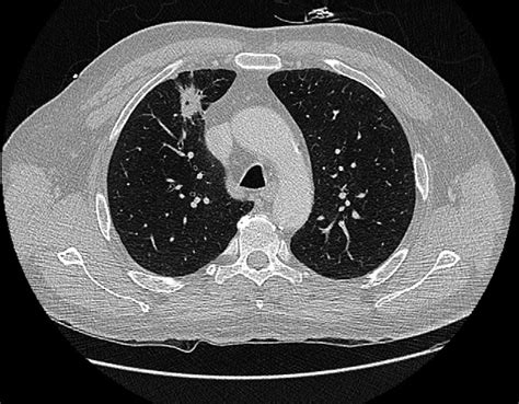 Chest Ct Showing A Solid Nodule To The Right Upper Lobe Lung Area Download Scientific Diagram