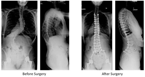 Posterior Spinal Instrumented Fusion For Adult Scoliosis Samuel K