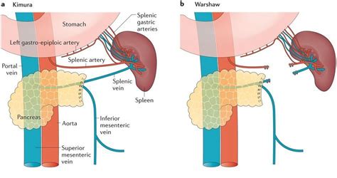 Distal Pancreatectomy