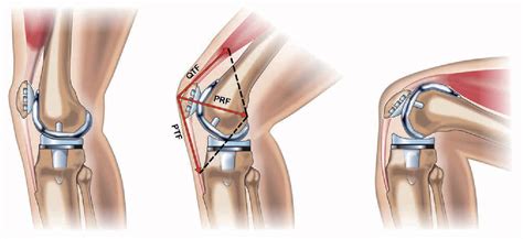 Figure 5 From Basic Kinematics And Biomechanics Of The Patellofemoral