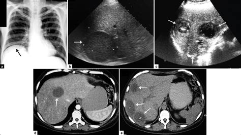 A Thoracic X Ray Of A Patient With Amoebic Liver Abscess Showing The