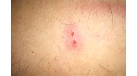 What Does A Spider Bite Look Like What Does A Spider