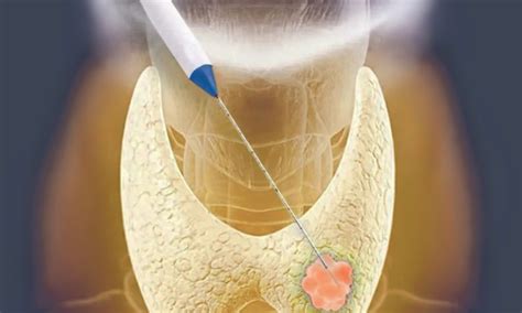 Radiofrequency Ablation Rfa For Thyroid Nodules What You Need To