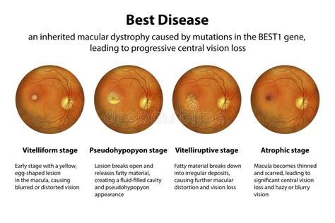 Stages of Best Vitelliform Macular Dystrophy, Illustration Stock Illustration - Illustration of ...