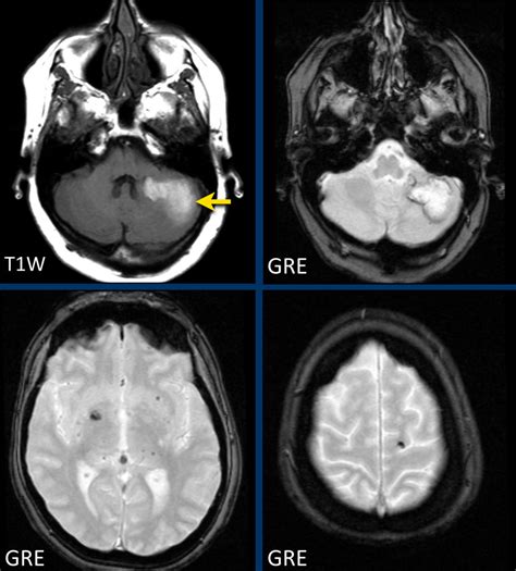 The Radiology Assistant Non Traumatic Intracranial Hemorrhage