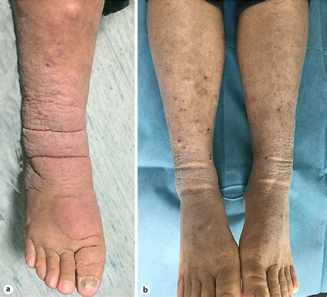 Figure 1 From Elephantiasic Pretibial Myxedema With Graves’ Disease Spontaneously Induced And