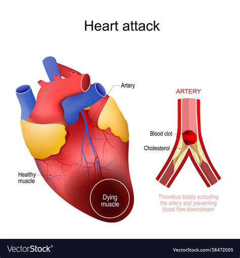 Heart Attack Myocardial Infarction Royalty Free Vector Image