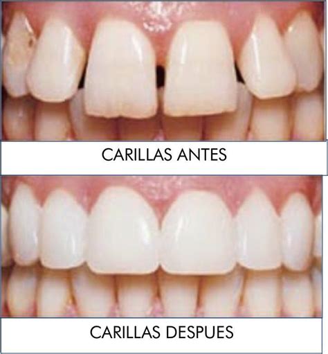 Est Tica Dental Carillas De Porcelana Cl Nica Boca Boca