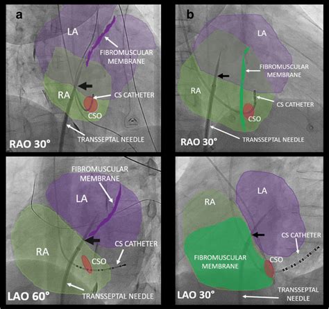 Transseptal Procedure