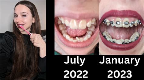 6 Month Adult Braces Update🦷 Progress First Dental Visit With Braces