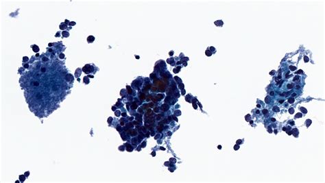 Pathology Outlines Merkel Cell Carcinoma