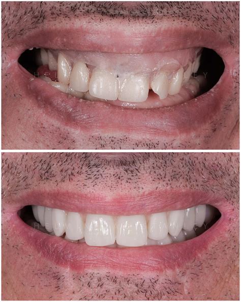 List 92 Pictures Before And After Pictures Of People With Dentures Latest