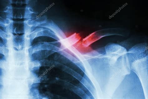 Fracture left clavicle — Stock Photo © stockdevil_666 #61372289